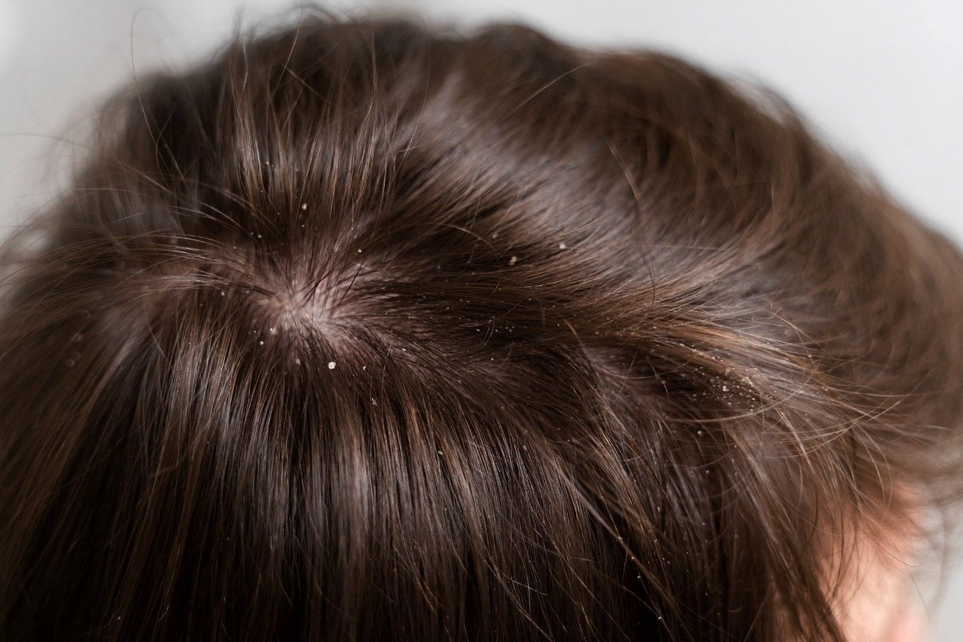Dandruff in hair (Image by Jcomp on Freepik)